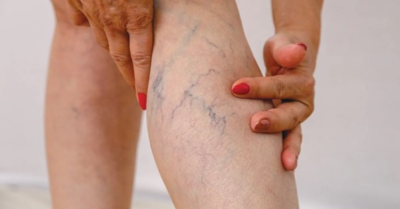 Varicose Veins- What you Need to Know About Them 